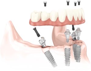 all-on-4-dental-implant-transparent
