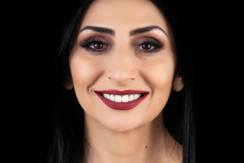 porcelain veneers after