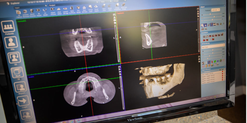 Computer monitor showing 3-D CBCT scan of a Smile Now patient's jaw for implant placement