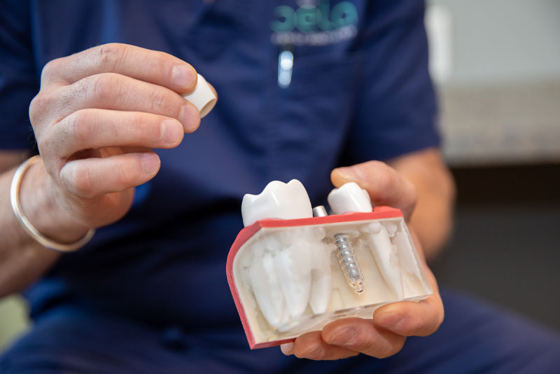 doctor holding dental implant model and single crown