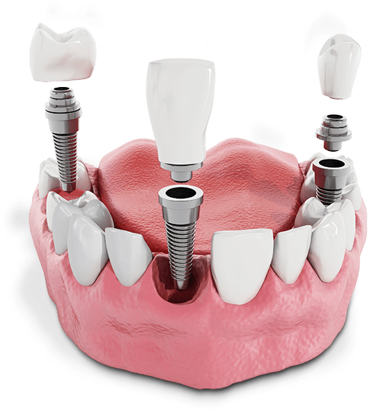 multiple dental implant model showing titanium implant, crown, and abutment