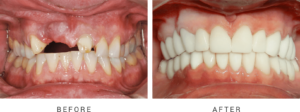 dental implant case