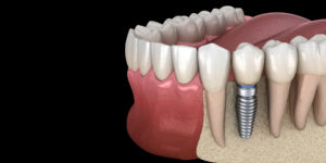 bone graft model