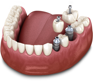 Cut out of a bottom jaw showing 2 dental implants with titanium implant crown and abutment