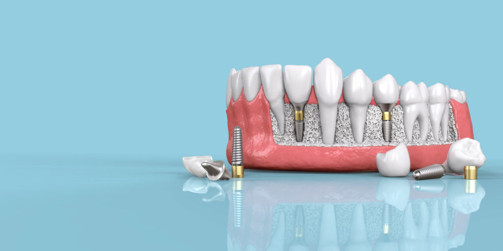 cutout of lower jaw dental implant model showing 2 implants