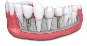 cutout of lower jaw dental implant model showing 2 implants