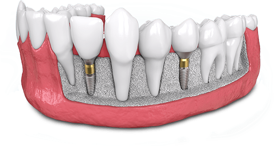 cutout of lower jaw dental implant model showing 2 implants