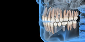 Artist rendering of a transparent face showing multiple dental implants next to natural teeth