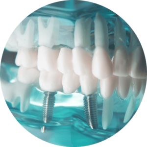 dental implant model