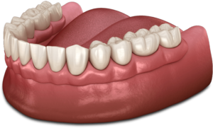 Traditional Dentures