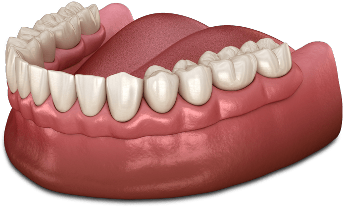 Traditional Dentures