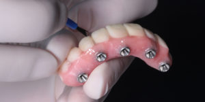 full arch dental implant