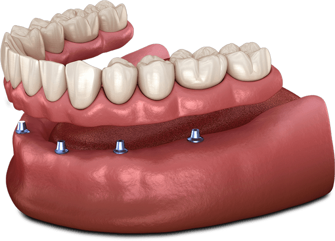 Implant Supported Dentures