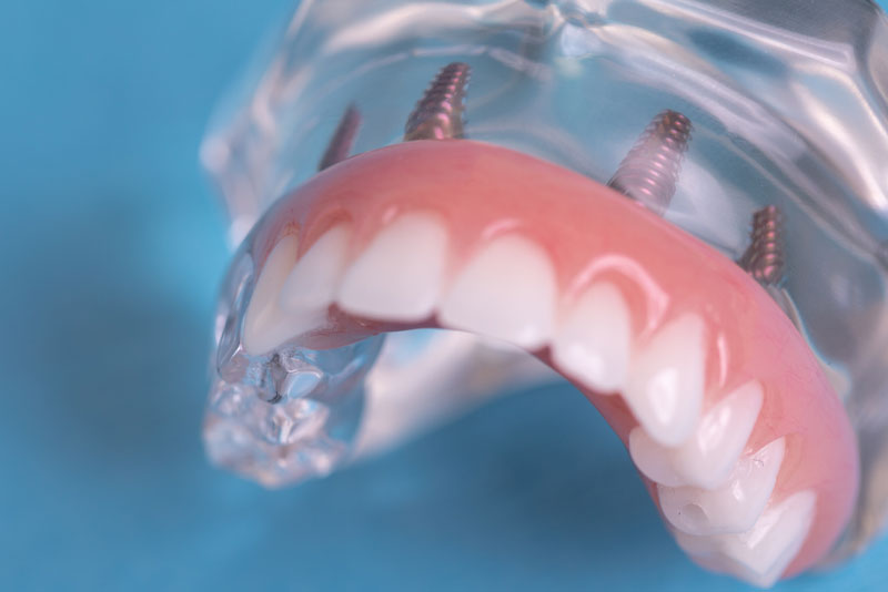 Full Arch Dental Implant