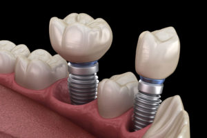 Dental Implant in Mouth