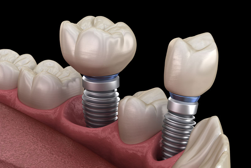 Dental Implant in Mouth