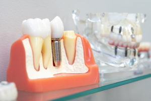 Dental Implant In Your Bone, Model