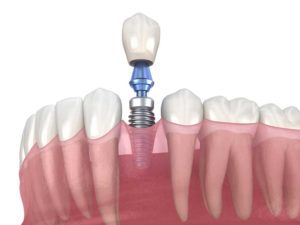 the three components of a dental implant
