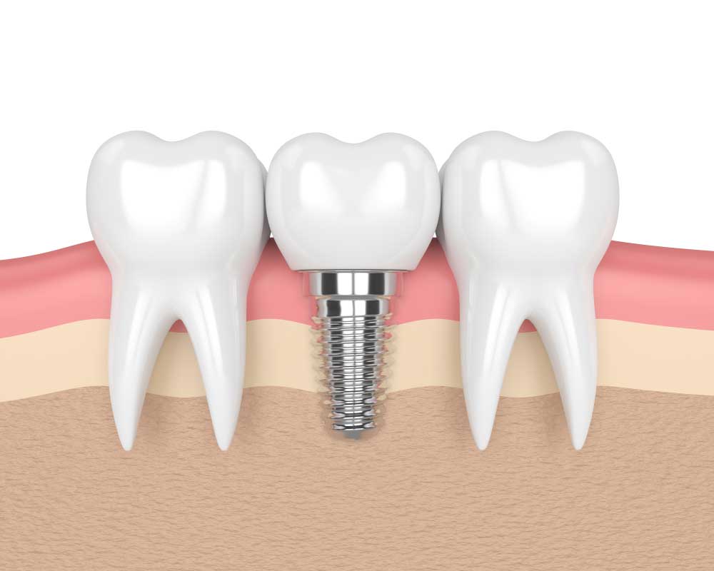 diagram of a placed dental implant