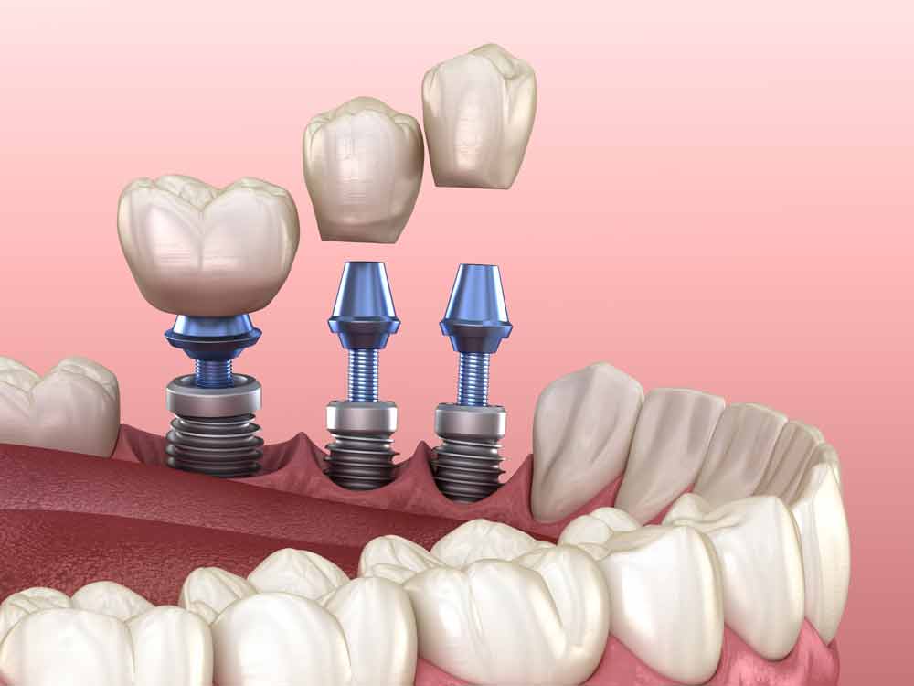 a model of three implants being placed