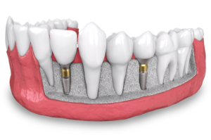a model of two placed dental implants