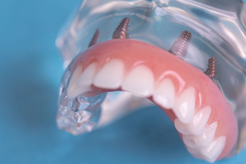 Full Mouth Dental Implants