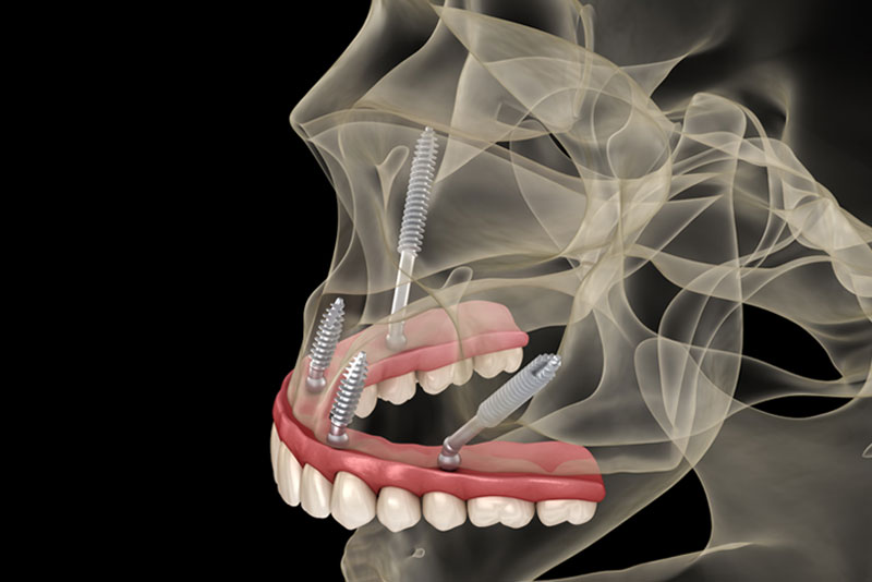 Artist rendering showing a zirconia prosthesis attached with zygomatic implants