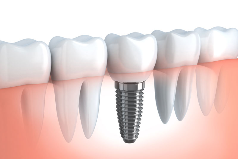 dental implant shown in gum-line