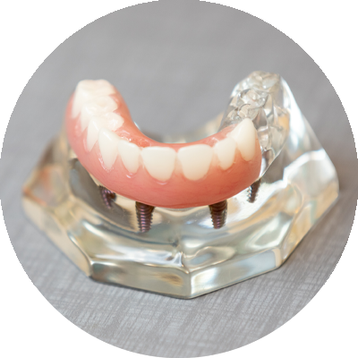 full arch dental implant model placed on counter