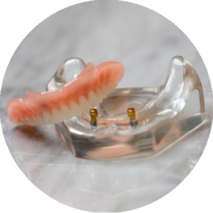 implant supported denture model placed on counter