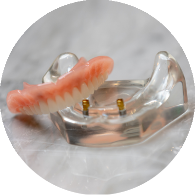 implant supported denture model placed on counter