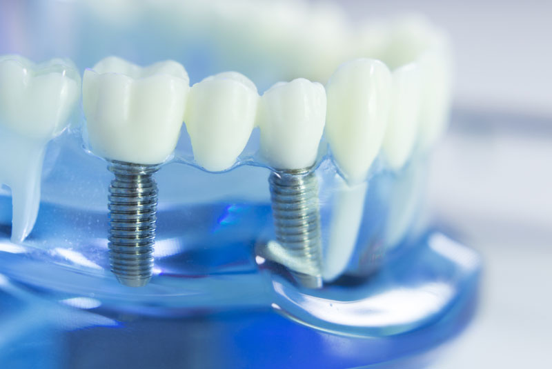 Multiple Dental Implants