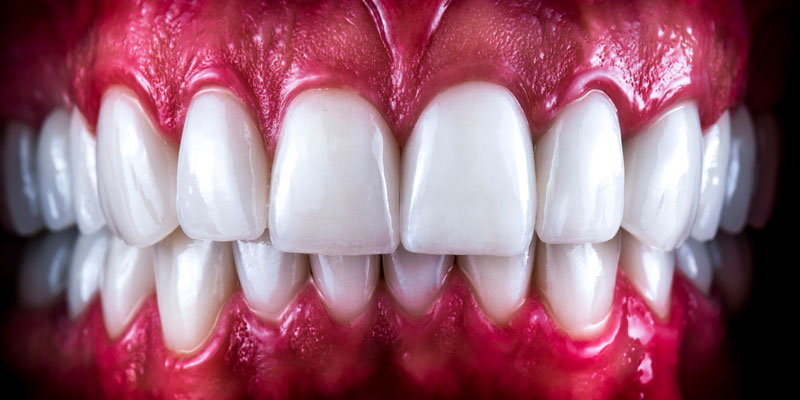 an image of a full mouth dental implant model.