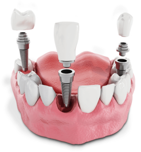 Multiple Dental Implant Model