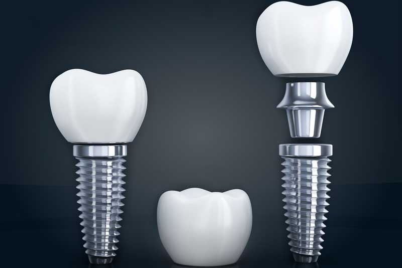 the three parts that makeup a dental implant