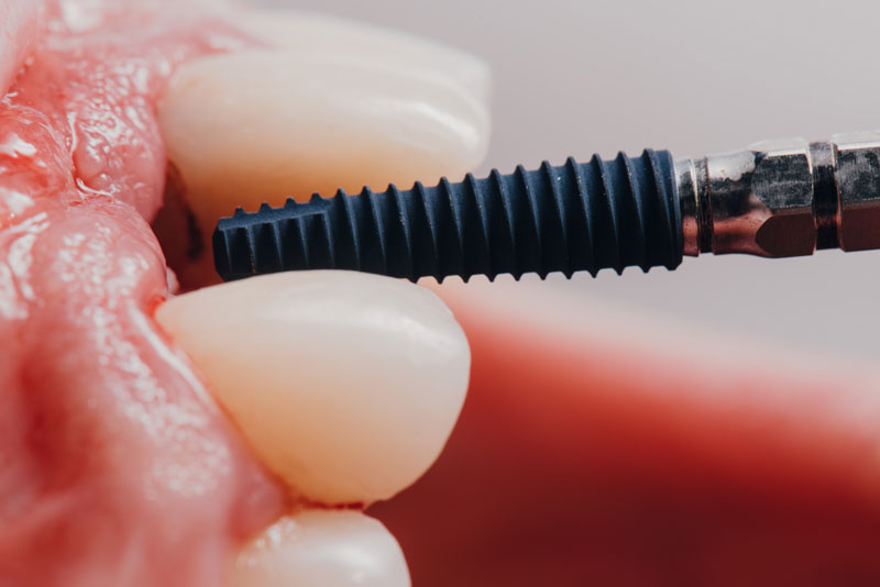 a photo of a zygomatic dental implant post being placed inside a patients gum's, which also have natural teeth in them.