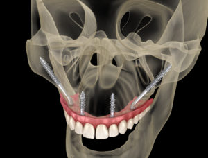 A picture of a patients skeleton where their zygomatic dental implants can be seen.