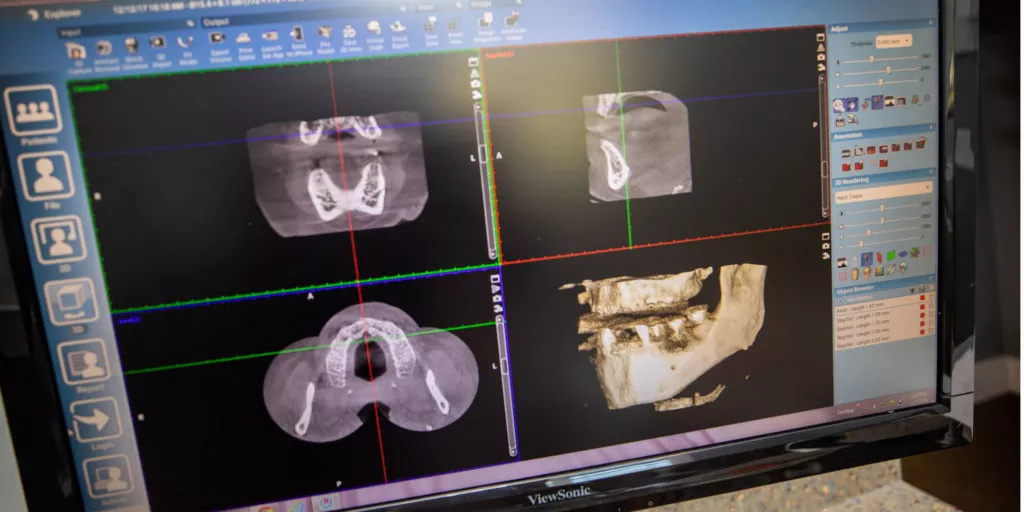 3D CBCT Scan Of Patient's Jaw For Implant Placement On Computer Monitor