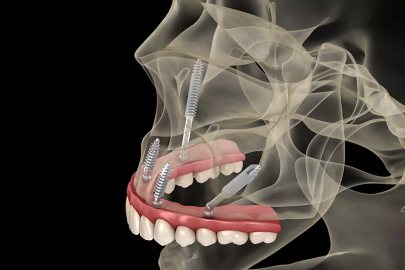 Zirconia Prosthesis Attached With Zygomatic Implants