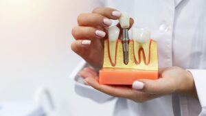 How to Care for Dental Implants: The Golden Rules for Lasting Brilliance