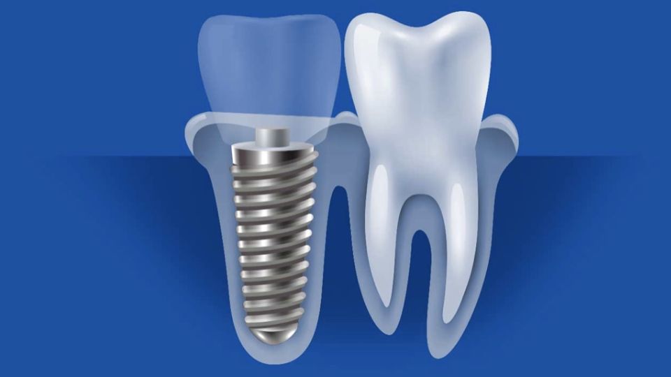 What You Need to Know About Titanium vs. Ceramic Dental Implants