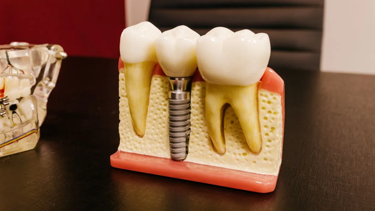 A Model Of Dental Implant