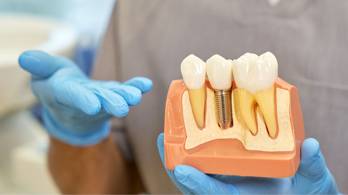 Understanding the Stability of Dental Implants