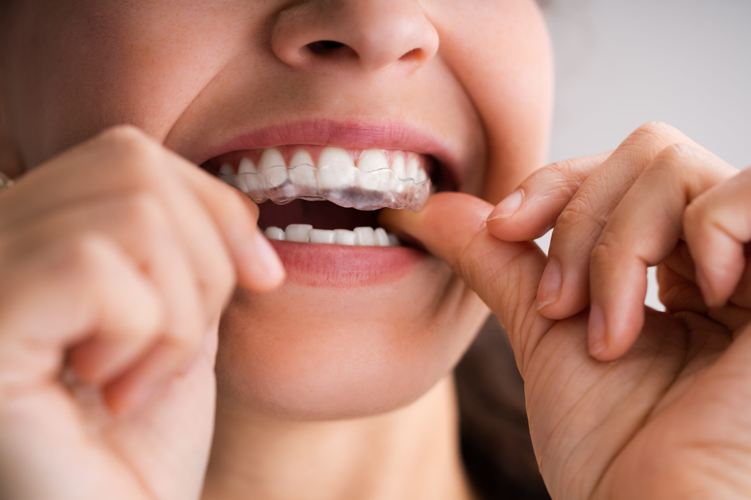 Person inserting a transparent dental retainer onto their upper teeth, showcasing their bright grin from Smile Now Arizona.