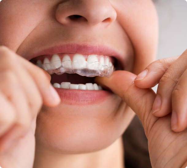Close-up of a person inserting a clear dental aligner onto their upper teeth at Smile Now Dental Implant Centers.